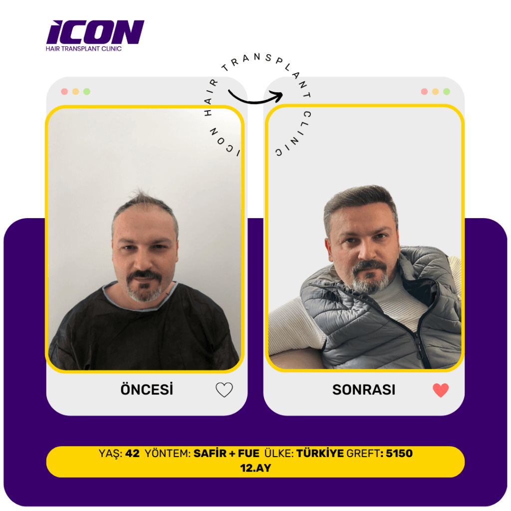 ICON Oncesi Sonrasi 6